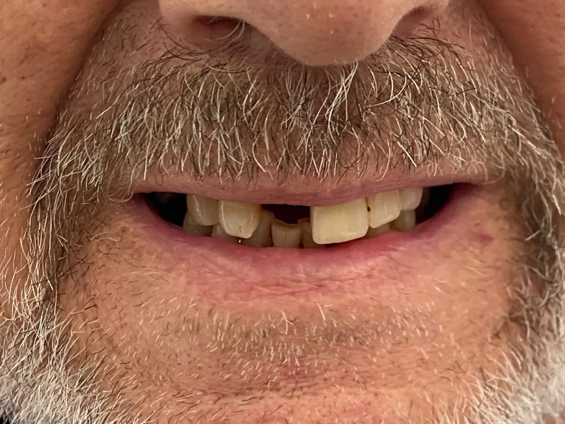 Failing upper teeth, All-on-4 before implant treatment