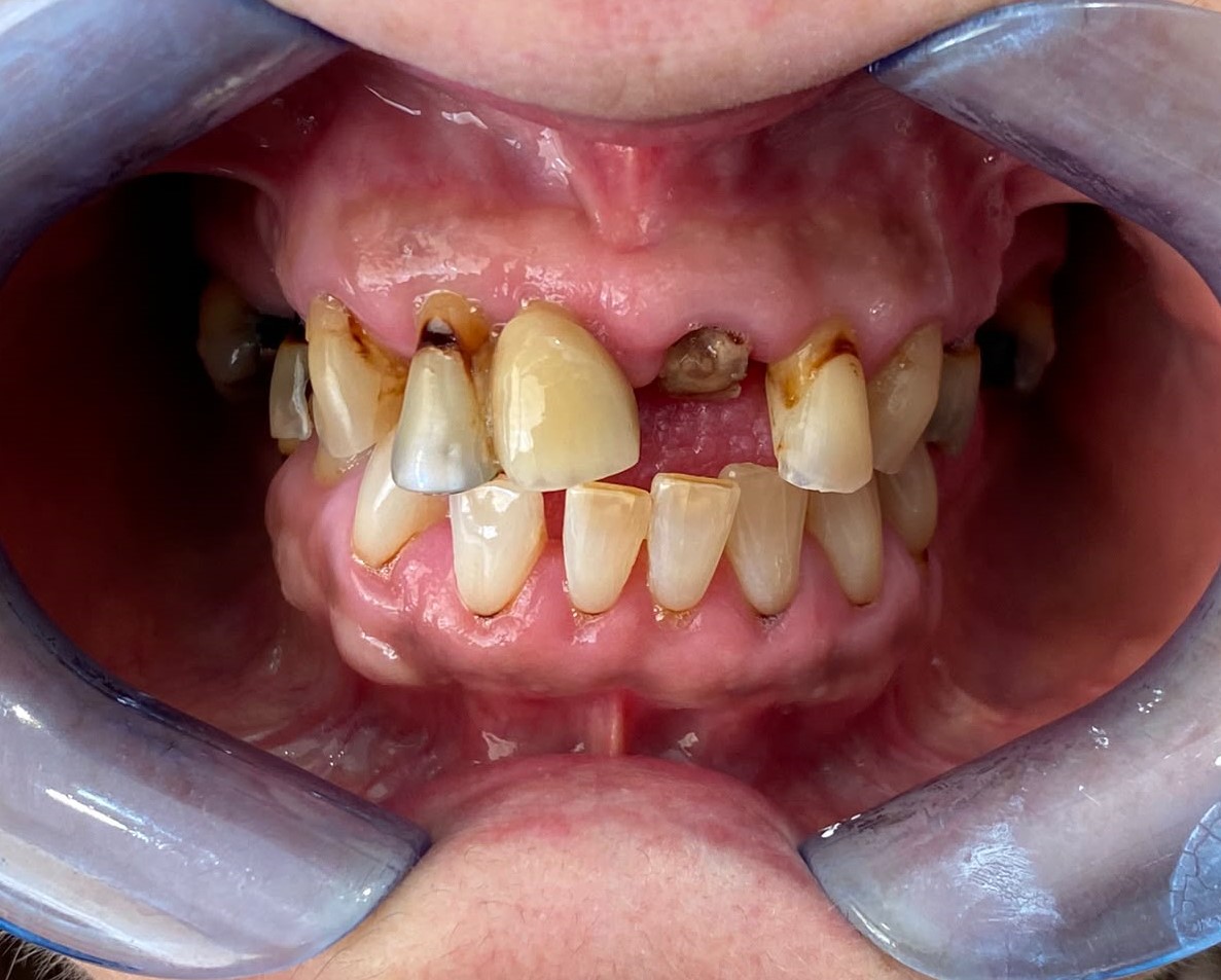 All-on-6 implant placement before implant treatment