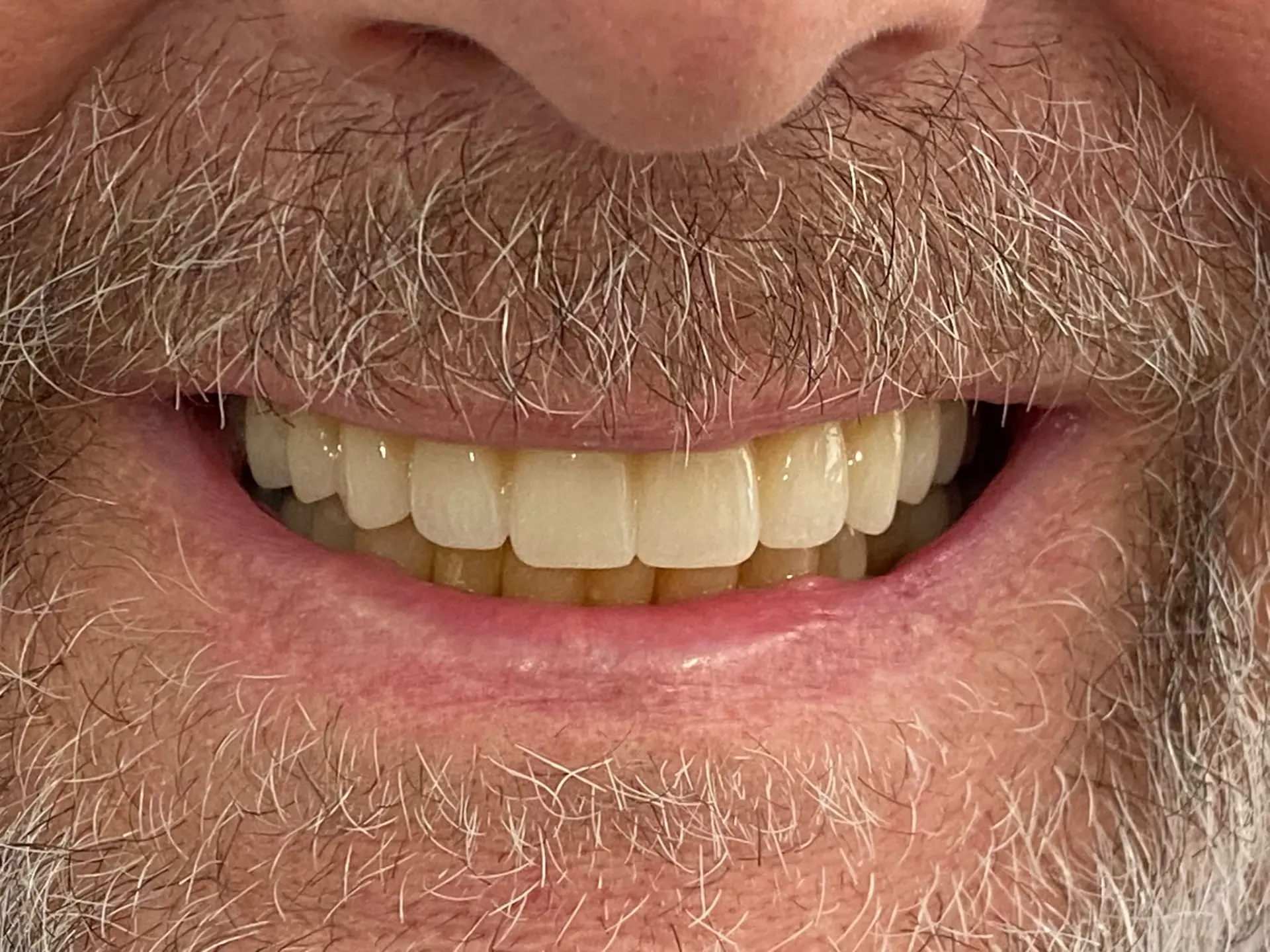 Failing upper teeth, All-on-4 after implant treatment